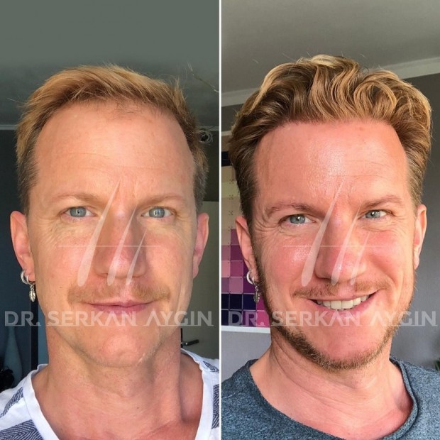Hair transplant turkey_before and after