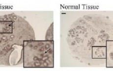 Cadherin-23 in Breast Cancer Cells