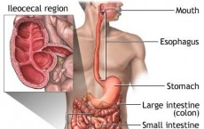 Crohn's disease