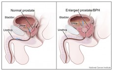 Prostate Cancer