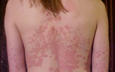 psoriasis 