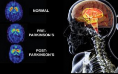 New Study Finds Treatment For Parkinson Disease. 