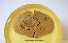 Glioblastoma multiforme