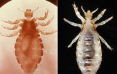 Head Louse and Body Louse