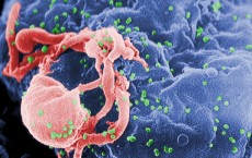 HIV infection