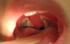 Tonsils 