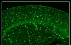 Beta-Amyloid Plaques in the Visual Cortex