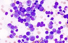 Multiple Myeloma