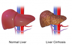 Liver Cirrhosis