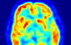 Transaxial slice of the brain of a 56 year old patient (male) taken with positron emission tomography (PET).