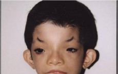 Full Facial Photograph of Individual with Hamamy Syndrome