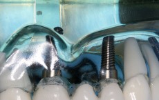 Dental Implant