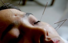 A Chinese Woman Receives Acupuncture Treatment