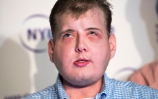 Extensive Face Transplant Patient Discusses Recovery In New York