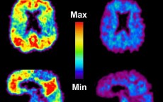 Brain Scans of Patients with AD