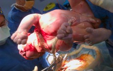 Baby born via Caesarean seaction