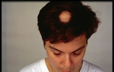 Alopecia Areata