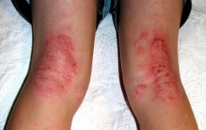 Eczema behind knees and on legs