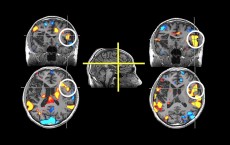 Brain scans of a patient suffering a stroke