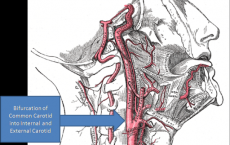 Gray's Anatomy with markup showing carotid artery bifurcation