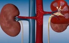 Kidney Disease