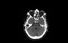 CT Scan Of The Head