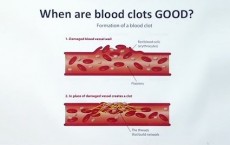 Blood Clot Treatment Found By Researchers Of Verseon Corporation