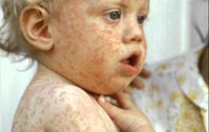 Measles Alert