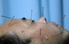 Acupuncture