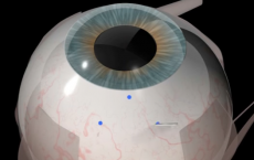 Retinal Implant Trial At John Radcliffe Hospital, Oxford