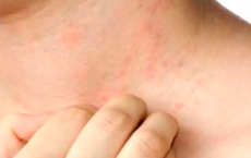 How To Get Rid Of Eczema