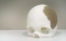 OsteoFab Patient Specific Cranial Device OPSCD made by Additive Manufacturing