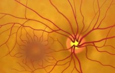 Animation: Detecting Glaucoma Through A Dilated Eye Exam