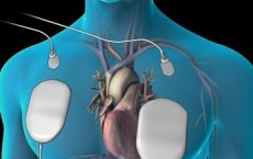 The Connection Between Heart Fibrillation And Abrupt Changes In Action Potential Of Heart Muscle Cells