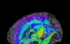 White Matter Pathways in Infants at Risk for Autism