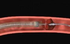 Clot Removal Stroke Treatment