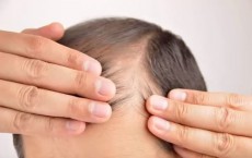 Scientists discover immune cells that trigger hair growth - paving the way to a cream treatment