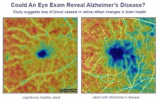 Could An Eye Doctor Diagnose Alzheimer's Before You Have Symptoms? (IMAGE)