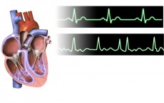  Atrial Fibrillation