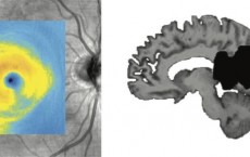 Eye Degeneration And Brain Lesion After Stroke (IMAGE)