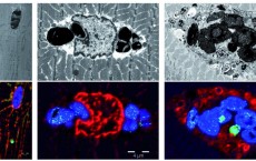 New Muscular Disease: Myoglobinopathy (IMAGE)