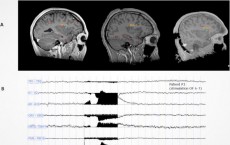 Does Stimulation of the Brain's Dorsal Anterior Insula Trigger Ecstasy? (IMAGE)