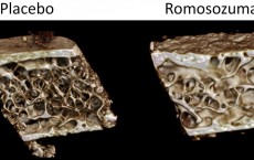 New Osteoporosis Therapy's Dual Effects on Bone Tissue (IMAGE)