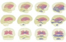 Vulnerable Brain Regions During Side Hit to the Head (IMAGE)