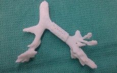 baby’s life was saved with this groundbreaking 3-D printed device that restored his breathing