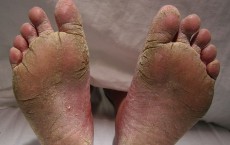 Loss of Sensation in Feet Linked to Cardiovascular Disease and Stroke in Diabetic Patients