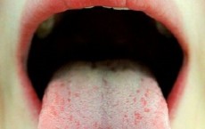 Obese Adults With Sleep Disorders Have Larger Tongue