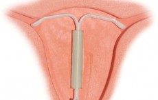 IUD 