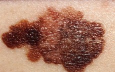 melanoma 