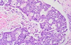 Carcinoma in Left Ovary